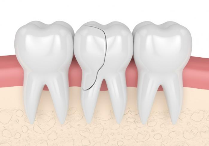 Dentiste pour couronne